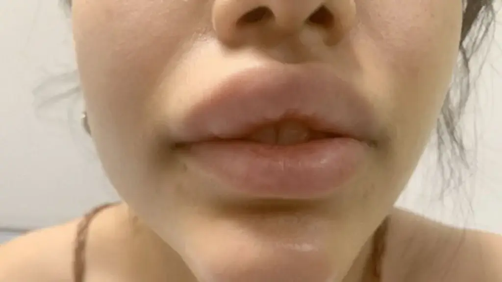 lip fillers side effect 