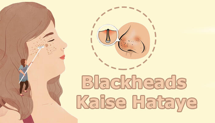 Blackheads kaise hataye