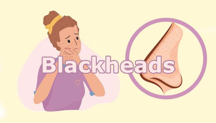 blackheads kaise hataye