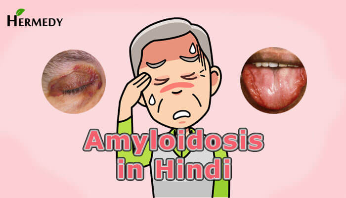 Amyloidosis in Hindi