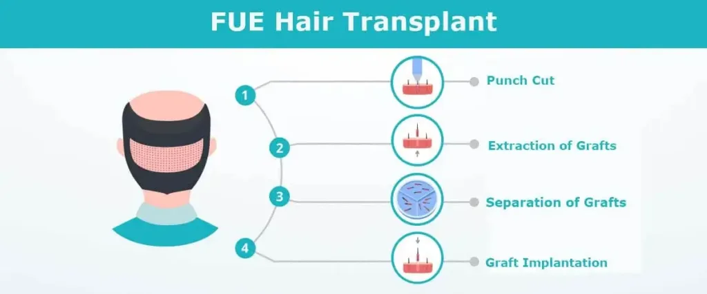 FUE-Follicular Unit Extraction