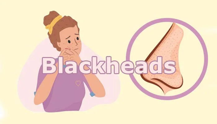 Blackheads kaise hataye | ब्लैक हेड्स हटाने के 8 नेचुरल रेमेडी blackheads kaise hataye